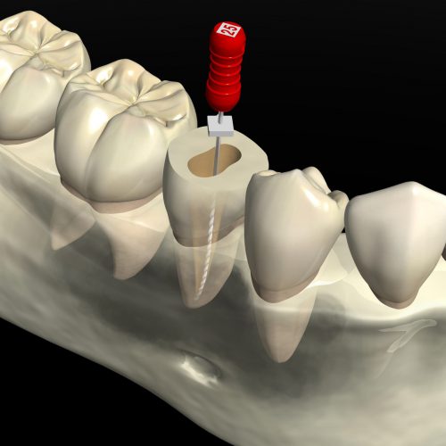 根管治療（歯の神経）