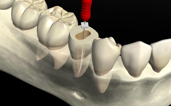 根管治療（歯の神経）
